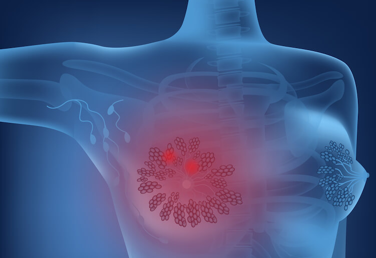 Diagram of a women's breast showing inflammation and possible cancer.