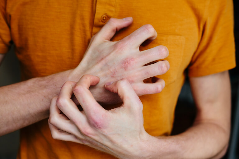 Man scratching his hands due to psoriasis